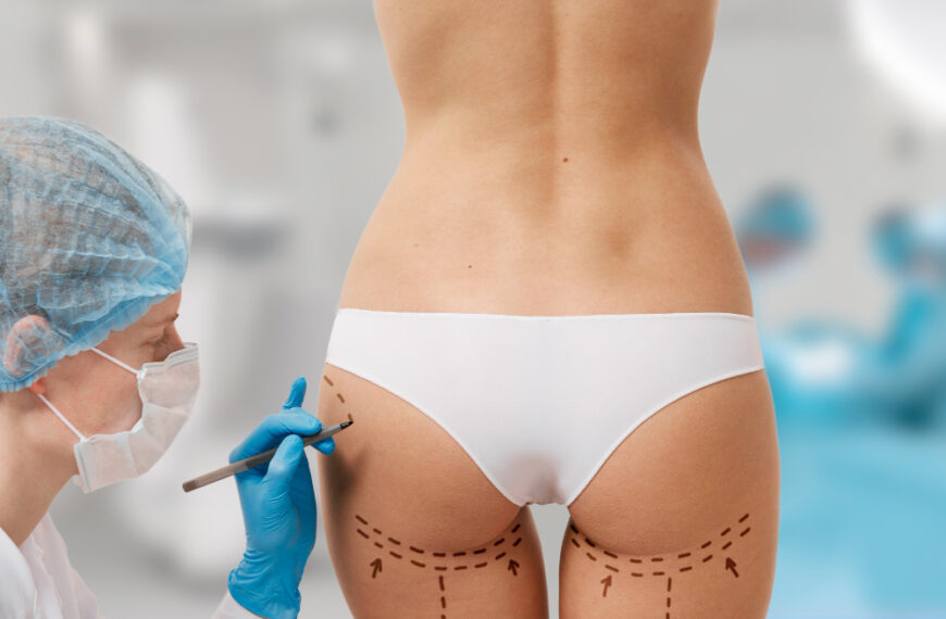 BBL (Brazilian Butt Lift) – co to jest i dla kogo przeznaczony jest zabieg?